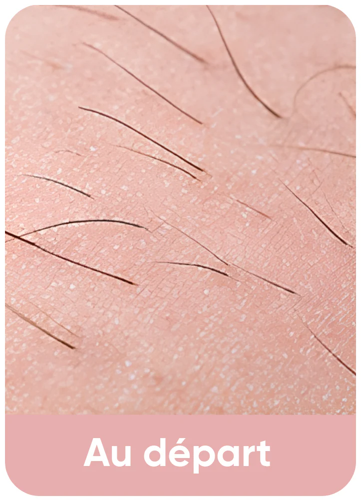 Avant épilation - poils visibles