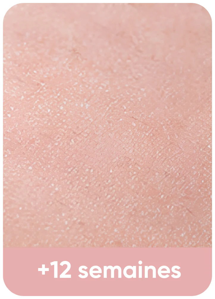 Après épilation IPL - peau lisse